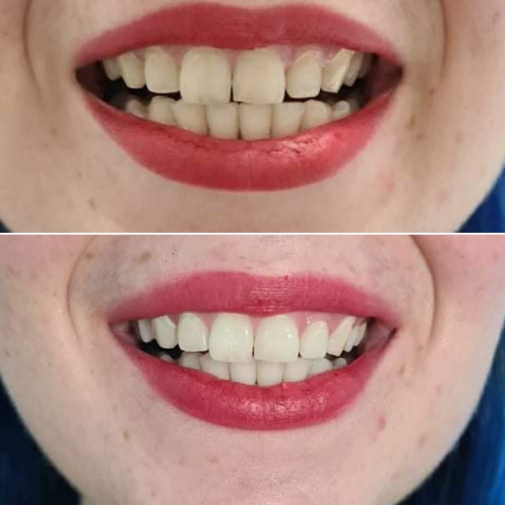 Teeth Whitening | Royale Beauty Therapy